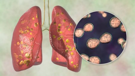 Foto de Histoplasmosis pulmonar, una infección fúngica causada por Histoplasma capsulatum. Ilustración 3D que muestra pequeños nódulos dispersos por los pulmones y vista de cerca de las levaduras de Histoplasma. - Imagen libre de derechos