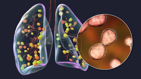 Foto de Histoplasmosis pulmonar, una infección fúngica causada por Histoplasma capsulatum. Ilustración 3D que muestra pequeños nódulos dispersos por los pulmones y vista de cerca de las levaduras de Histoplasma. - Imagen libre de derechos
