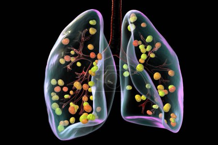 Foto de Histoplasmosis pulmonar, una infección fúngica causada por Histoplasma capsulatum. Ilustración 3D que muestra pequeños nódulos dispersos por los pulmones. - Imagen libre de derechos