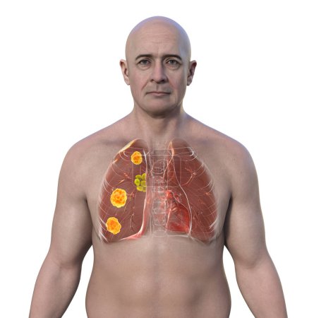 Téléchargez les photos : Blastomycose pulmonaire avec lésions pulmonaires et ganglions lymphatiques bronchiques dilatés, illustration 3D. - en image libre de droit