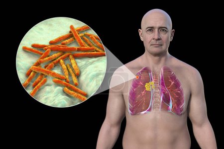 Primary lung tuberculosis in a man. 3D illustration showing lungs with the Ghon complex and mediastinal lymphadenitis, along with close-up view of Mycobacterium tuberculosis bacteria.