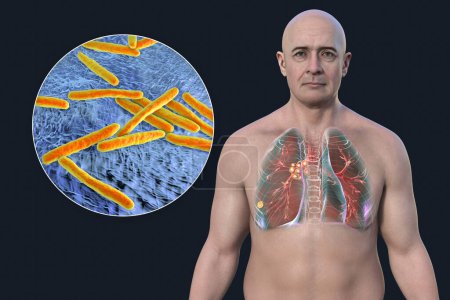 Foto de Tuberculosis pulmonar primaria en un hombre con el complejo Ranke, ilustración 3D que muestra lesiones pulmonares y linfadenitis mediastínica, junto con una vista cercana de la bacteria Mycobacterium tuberculosis. - Imagen libre de derechos