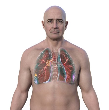 Téléchargez les photos : Tuberculose pulmonaire primaire chez un homme avec le complexe Ranke, illustration 3D mettant en évidence des lésions pulmonaires et une adénite médiastinale. - en image libre de droit