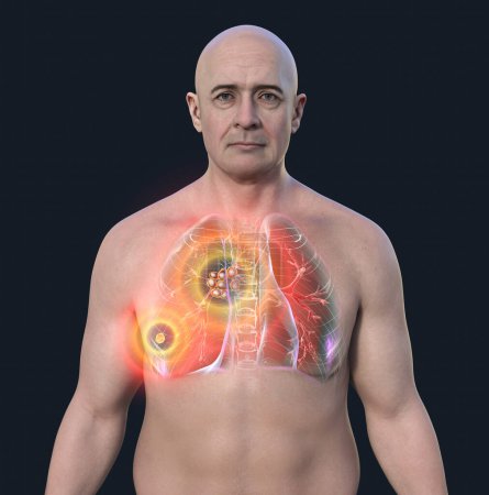 Téléchargez les photos : Tuberculose pulmonaire primaire chez un homme avec le complexe Ranke, illustration 3D mettant en évidence des lésions pulmonaires et une adénite médiastinale. - en image libre de droit
