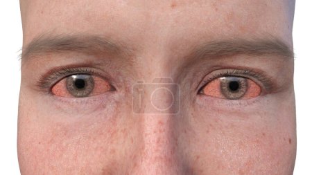 Photo for 3D illustration portraying a person with dry eyes, a condition marked by insufficient tear production causing discomfort and irritation. - Royalty Free Image