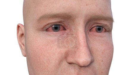 Foto de Ilustración en 3D que retrata a una persona con los ojos secos, una condición marcada por una producción insuficiente de lágrimas que causa molestias e irritación. - Imagen libre de derechos
