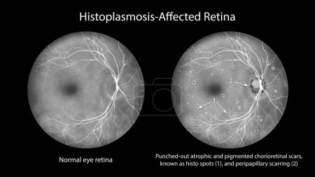 Foto de Retina en el Síndrome de Histoplasmosis Ocular Presunta, como se observa en la angiografía fluoresceínica, la ilustración muestra cicatrices coriorretinianas atróficas y pigmentadas perforadas (manchas histo) y cicatrices peripapilares - Imagen libre de derechos
