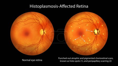 Photo for Retina in Presumed Ocular Histoplasmosis Syndrome as seen in ophthalmoscopy, illustration shows punched-out atrophic and pigmented chorioretinal scars (histo spots) and peripapillary scarring. - Royalty Free Image