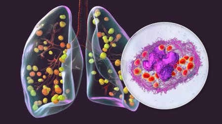 Foto de Histoplasmosis pulmonar, una infección fúngica causada por Histoplasma capsulatum. Ilustración 3D que muestra pequeños nódulos dispersos en los pulmones y vista de cerca de las levaduras de Histoplasma dentro de los macrófagos pulmonares. - Imagen libre de derechos