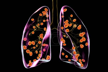 Téléchargez les photos : Histoplasmose pulmonaire, une infection fongique causée par Histoplasma capsulatum. Illustration 3D montrant de petits nodules dispersés dans les poumons. - en image libre de droit