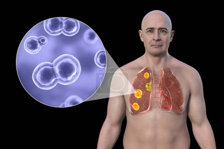 Foto de Blastomicosis pulmonar con lesiones pulmonares y ganglios linfáticos bronquiales agrandados, y vista de cerca del hongo Blastomyces dermatitidis, ilustración 3D. - Imagen libre de derechos