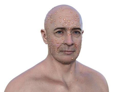 Illustration 3D représentant l'homme avec éruption cutanée due aux virus de la variole (variole, alaskapox, variole du singe), facilitant l'identification et la compréhension.