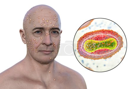 3D illustration depicts man with rash from pox viruses (smallpox, Alaskapox, monkeypox), alongside with close-up view of Poxviridae viruses.