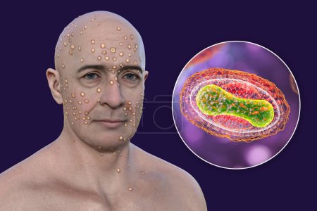 3D-Illustration zeigt Mann mit Hautausschlag durch Pockenviren (Pocken, Alaskapox, Affenpocken), zusammen mit Nahaufnahme von Poxviridae-Viren.