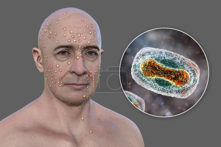 Photo for 3D illustration depicts man with rash from pox viruses (smallpox, Alaskapox, monkeypox), alongside with close-up view of Poxviridae viruses. - Royalty Free Image