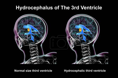 Foto de Una ilustración científica en 3D que representa el agrandamiento aislado del tercer ventrículo cerebral (derecha) en comparación con el tercer ventrículo de tamaño normal (izquierda)). - Imagen libre de derechos