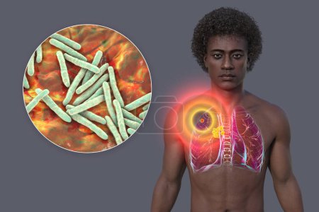 Primary lung tuberculosis. 3D illustration featuring a man with transparent skin revealing lungs with the Ghon complex and mediastinal lymphadenitis, with close-up view of Mycobacterium tuberculosis.