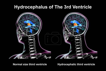 A 3D scientific illustration depicting isolated enlargement of the third brain ventricle (right) compared to the normal size third ventricle (left).