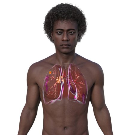 Primary lung tuberculosis in a man with the Ranke complex, 3D illustration showing pulmonary lesions and mediastinal lymphadenitis.