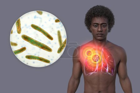 Primary lung tuberculosis in a man with the Ranke complex, 3D illustration showing pulmonary lesions and mediastinal lymphadenitis, along with close-up view of Mycobacterium tuberculosis bacteria.