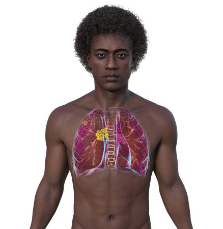 Téléchargez les photos : La tuberculose pulmonaire primaire. Illustration 3D représentant un homme à la peau transparente révélant des poumons avec le complexe Ghon et une lymphadénite médiastinale. - en image libre de droit
