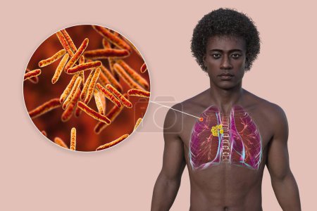Primary lung tuberculosis. 3D illustration featuring a man with transparent skin revealing lungs with the Ghon complex and mediastinal lymphadenitis, with close-up view of Mycobacterium tuberculosis.