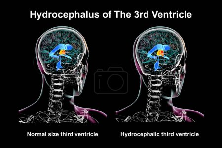Téléchargez les photos : Illustration scientifique 3D représentant l'agrandissement isolé du troisième ventricule cérébral (droite) par rapport au troisième ventricule de taille normale (gauche)). - en image libre de droit