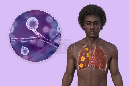 Lungenblastomykose bei einem Mann mit Lungenläsionen und vergrößerten Bronchiallymphknoten und Nahaufnahme des Pilzes Blastomyces dermatitidis, 3D-Illustration.