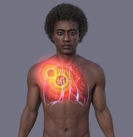 Primary lung tuberculosis in a man with the Ranke complex, 3D illustration showing pulmonary lesions and mediastinal lymphadenitis.