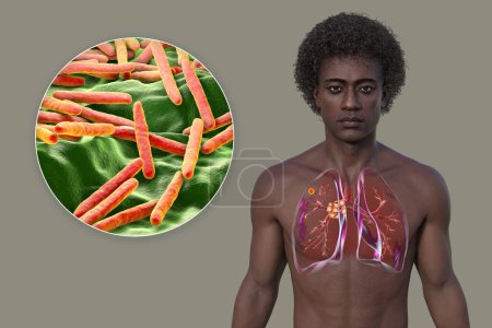 Primary lung tuberculosis in a man with the Ranke complex, 3D illustration showing pulmonary lesions and mediastinal lymphadenitis, along with close-up view of Mycobacterium tuberculosis bacteria.