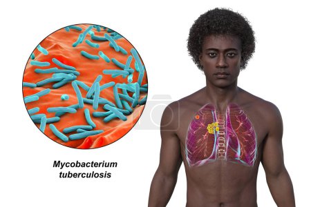 Tuberculosis pulmonar primaria. Ilustración 3D con un hombre de piel transparente que revela pulmones con el complejo Ghon y linfadenitis mediastínica, con vista de cerca de Mycobacterium tuberculosis.