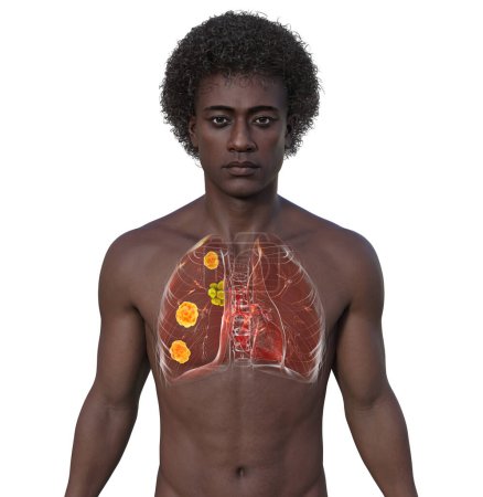 Lungenblastomykose bei einem Mann mit Lungenläsionen und vergrößerten Bronchiallymphknoten, 3D-Illustration.