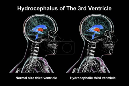 Photo for A 3D scientific illustration depicting isolated enlargement of the third brain ventricle (right) compared to the normal size third ventricle (left), side view. - Royalty Free Image