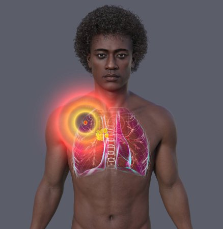 Tuberculosis pulmonar primaria. Ilustración 3D con un hombre de piel transparente revelando pulmones con el complejo Ghon y linfadenitis mediastínica.