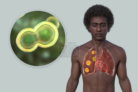 Blastomicosis pulmonar en un hombre con lesiones pulmonares y ganglios linfáticos bronquiales agrandados, y vista de cerca del hongo Blastomyces dermatitidis, ilustración 3D.