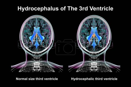 A 3D scientific illustration depicting isolated enlargement of the third brain ventricle (right) compared to the normal size third ventricle (left), top view.