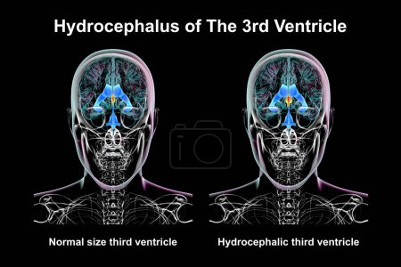 A 3D scientific illustration depicting isolated enlargement of the third brain ventricle (right) compared to the normal size third ventricle (left), front view.