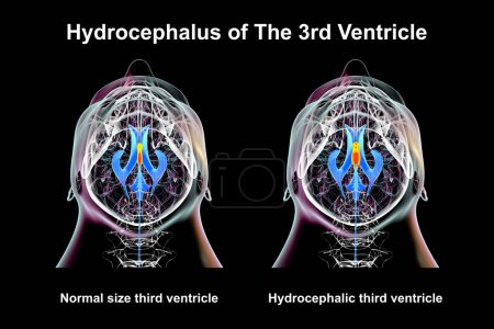 A 3D scientific illustration depicting isolated enlargement of the third brain ventricle (right) compared to the normal size third ventricle (left), bottom view.