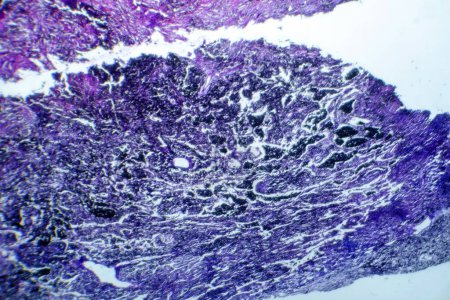 Foto de Fotomicrografía de tejido pulmonar que representa patología de silicosis bajo un microscopio, revelando acumulación de partículas de sílice en alvéolos y fibrosis. - Imagen libre de derechos