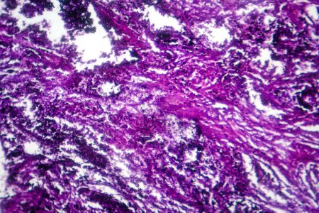 Fotomicrografía de tejido pulmonar que representa patología de silicosis bajo un microscopio, revelando acumulación de partículas de sílice en alvéolos y fibrosis.
