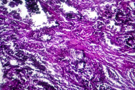 Téléchargez les photos : Photomicrographie des tissus pulmonaires représentant la pathologie de la silicose au microscope, révélant l'accumulation de particules de silice dans les alvéoles et la fibrose. - en image libre de droit
