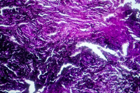 Photomicrographie des tissus pulmonaires représentant la pathologie de la silicose au microscope, révélant l'accumulation de particules de silice dans les alvéoles et la fibrose.