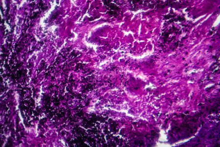 Photomicrograph of lung tissue depicting silicosis pathology under a microscope, revealing silica particle accumulation in alveoli and fibrosis.