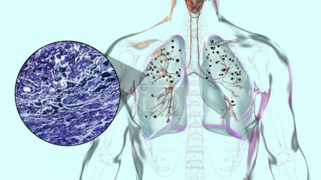 Foto de Ilustración 3D y micrografía de luz que representa los pulmones afectados por la silicosis dentro de un cuerpo humano, revelando nódulos silicóticos oscuros, haciendo hincapié en los problemas de salud respiratoria debido a la exposición al sílice. - Imagen libre de derechos