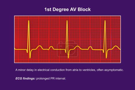 3D illustration of an ECG displaying 1st degree AV block, a cardiac conduction disorder.