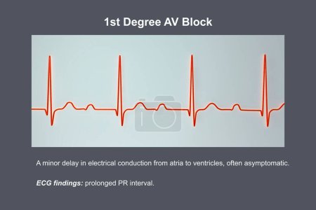 Illustration 3D d'un ECG affichant un bloc AV au 1er degré, un trouble de conduction cardiaque.