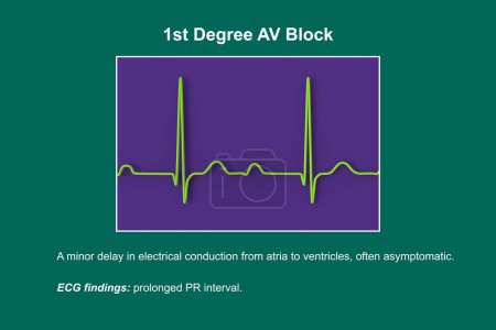 3D-Illustration eines EKGs mit AV-Block 1. Grades, einer Herzleitungsstörung.