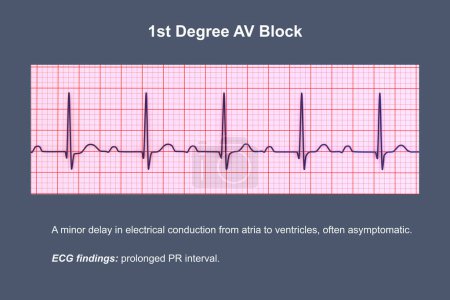 Ilustración 3D de un ECG que muestra bloqueo AV de primer grado, un trastorno de la conducción cardíaca.