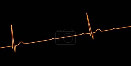 Téléchargez les photos : Illustration 3D visualisant un ECG avec bloc AV au 3ème degré, montrant une dissociation complète entre les rythmes auriculaire et ventriculaire. - en image libre de droit