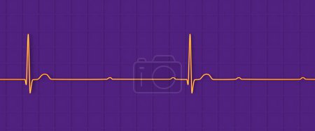 3D-Illustration zur Visualisierung eines EKGs mit AV-Block 3. Grades, die die vollständige Dissoziation zwischen atrialem und ventrikulärem Rhythmus zeigt.